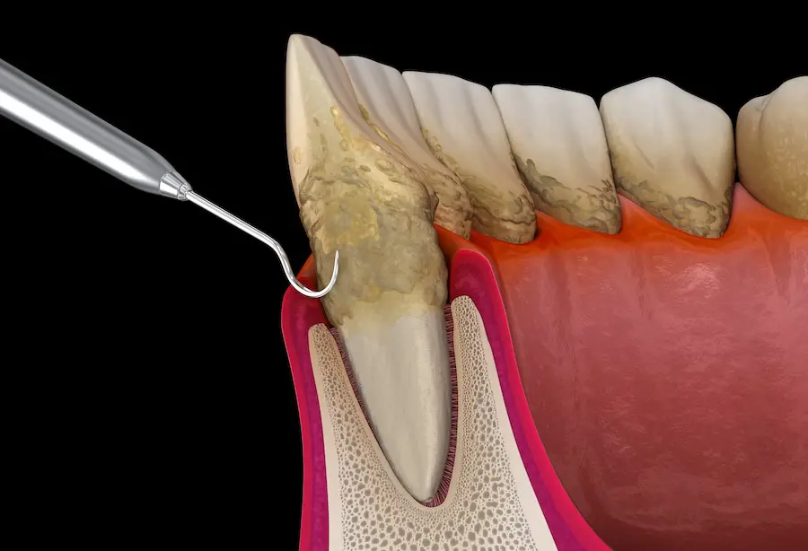 Gum Disease Treatment (Periodontal Therapy)